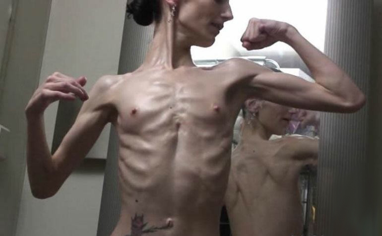 Самый худой человек в мире